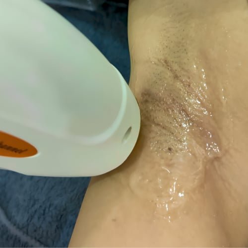 A white handheld device held against a client's underarm, the skin prepared with gel