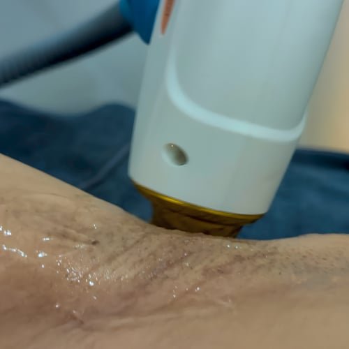 Close-up of a handheld device with a gold tip working across the skin of the underarm