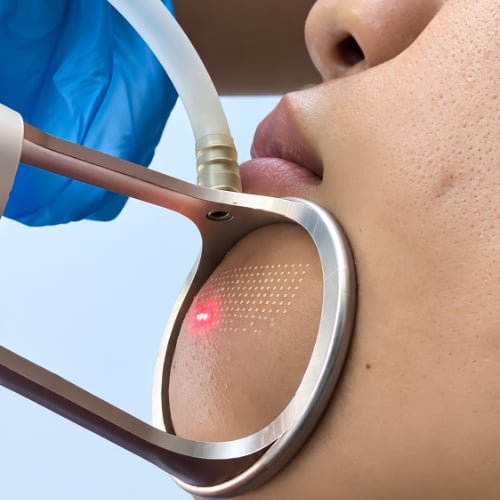 CO₂ Fractional Laser at The Better Face