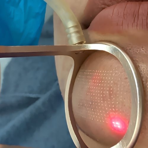 A CO2 fractional laser handpiece held against a client's cheek, its grid of aiming dots and red guide light on the skin