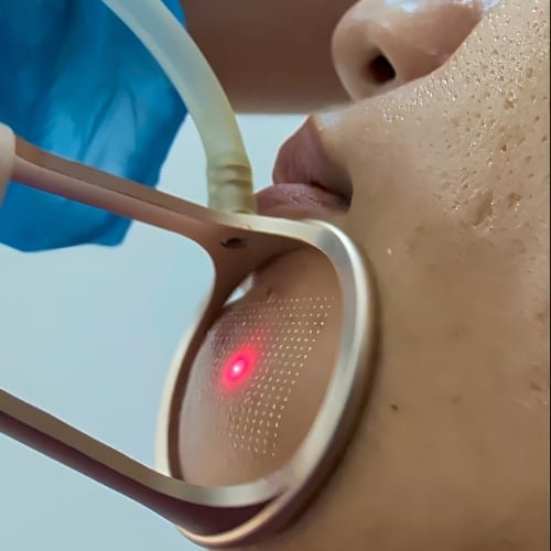 Side view of the CO2 laser handpiece on a client's cheek beside the nose, the red aiming light visible