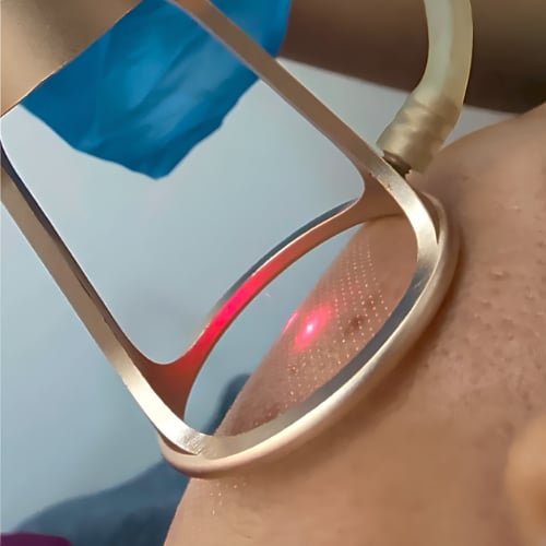 Close-up of the CO2 laser frame pressed to the skin, the red guide beam lighting the treatment area