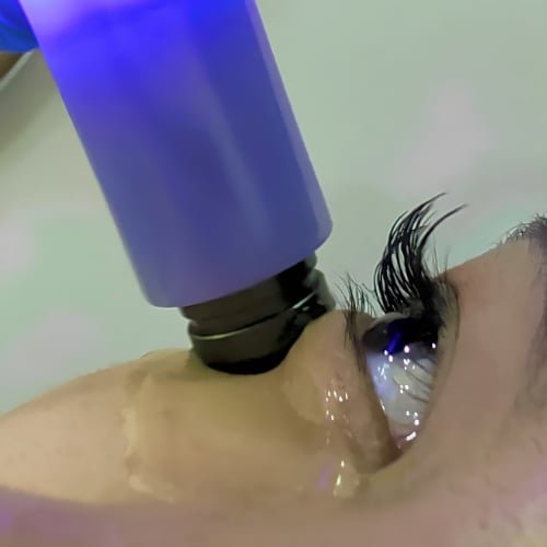 An Exilis handpiece with a violet glow working over gel on the skin just below a client's eye