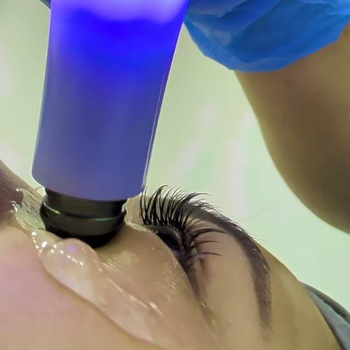 A clinician in blue gloves guiding the Exilis handpiece across the skin beside a client's eye