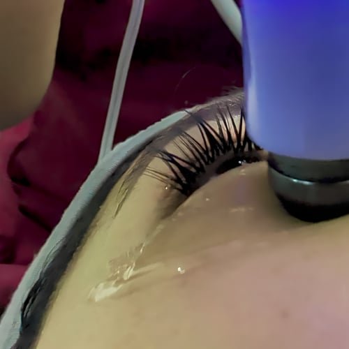 Close-up of the Exilis handpiece tip gliding over gel along a client's lower lid