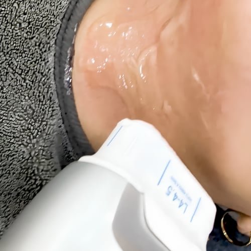 A HIFU cartridge pressed under a client's jawline, with ultrasound gel on the skin