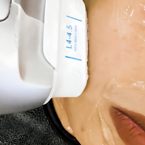 A HIFU cartridge marked L4-4.5 held against a client's cheek over a layer of gel