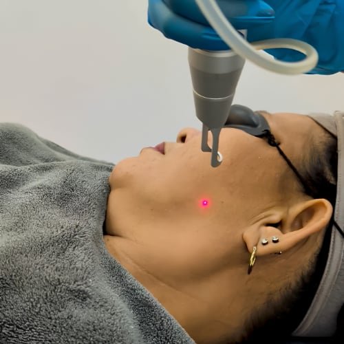 Side view of a laser handpiece above a client's cheek, a red aiming dot on the skin