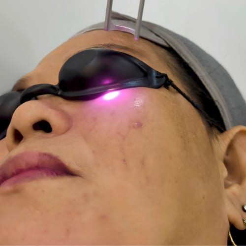 Close-up of a laser pulse on a client's cheek beside the protective eyewear