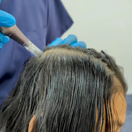 A clinician in blue gloves applying treatment to a client's scalp along the hair parting with a handheld applicator