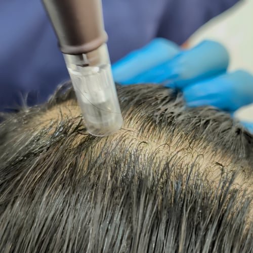 Close-up of a handheld applicator tip working across a client's scalp