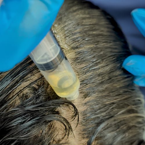 A clinician in blue gloves holding a syringe of pale yellow solution against a client's scalp