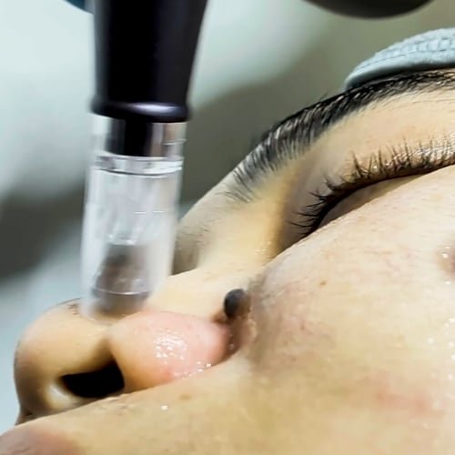 A microneedling pen applying PRP to the skin beside a client's nose