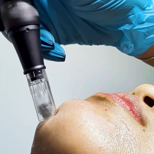 A clinician in blue gloves working a microneedling pen along a client's chin