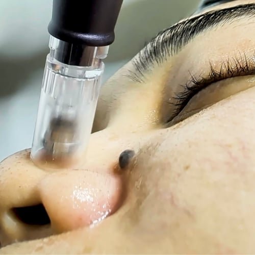 Close-up of a microneedling pen on the cheek, the client's eyes closed