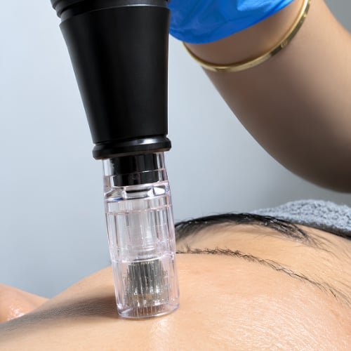 PRP (Platelet-Rich Plasma) at The Better Face