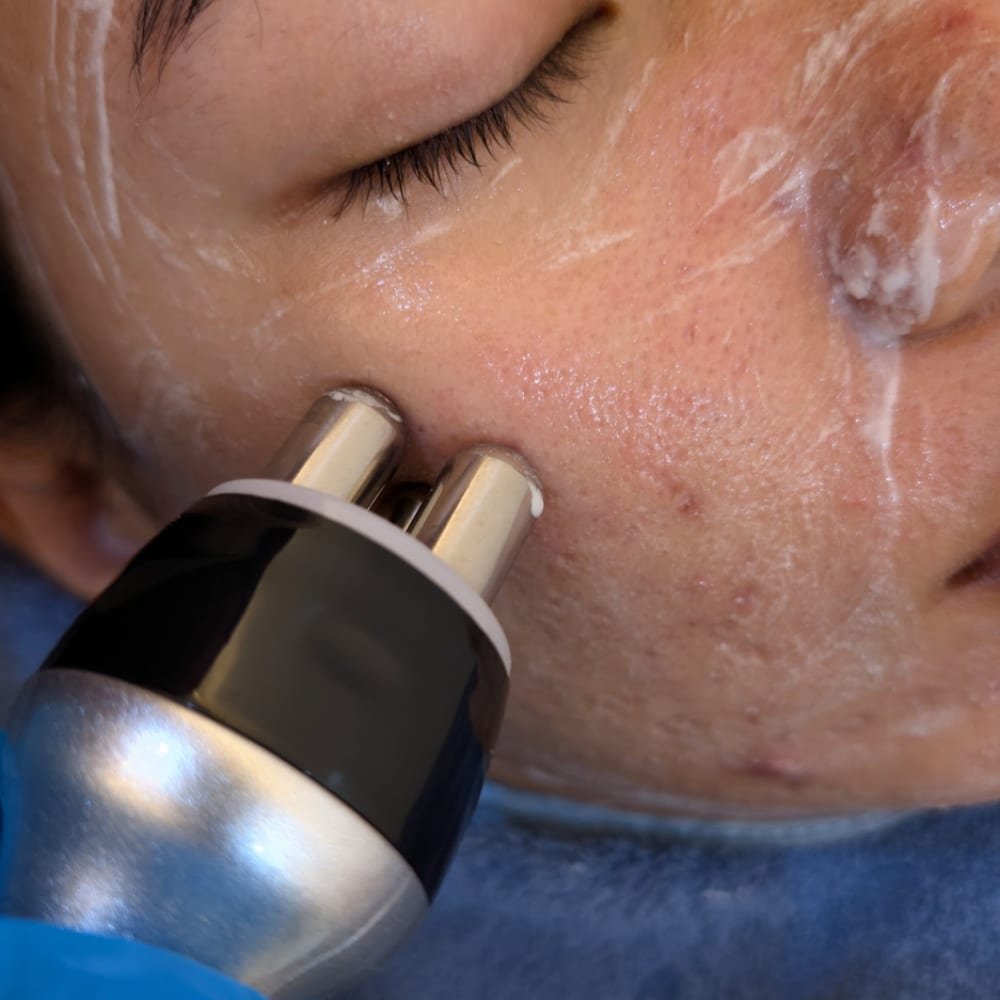 Radio Frequency (RF) at The Better Face