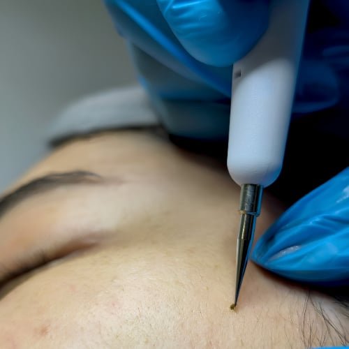 A clinician in blue gloves touching a fine-tipped device to a small growth on a client's forehead