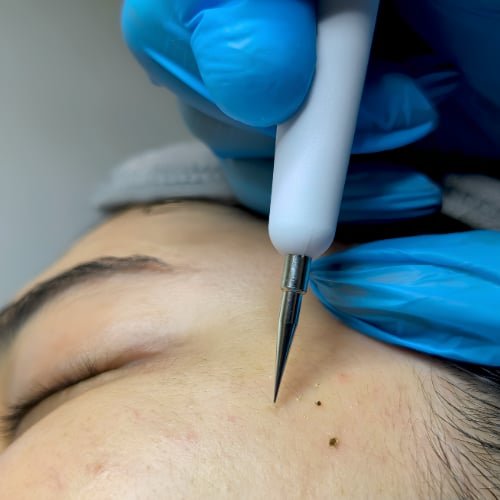 A fine-tipped device held above small skin growths near a client's temple