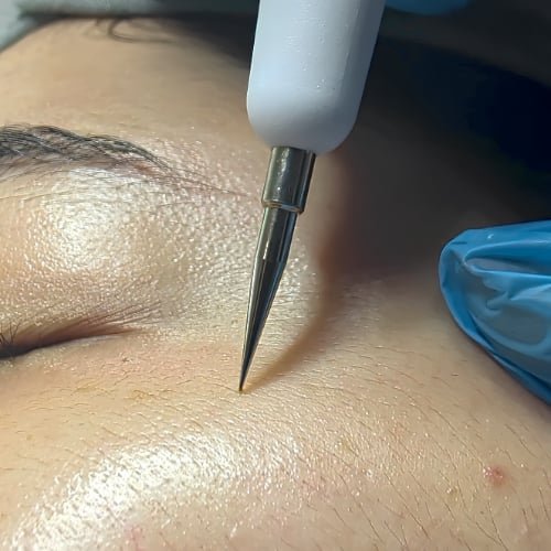 Close-up of the device's fine metal tip at the skin beside a client's closed eye