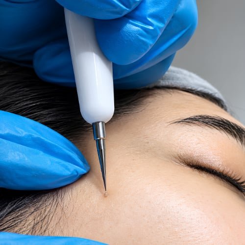 Warts Removal — Per Area at The Better Face