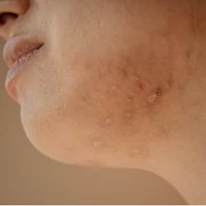 Skin acne problem