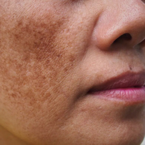 Pigmentation skin problem